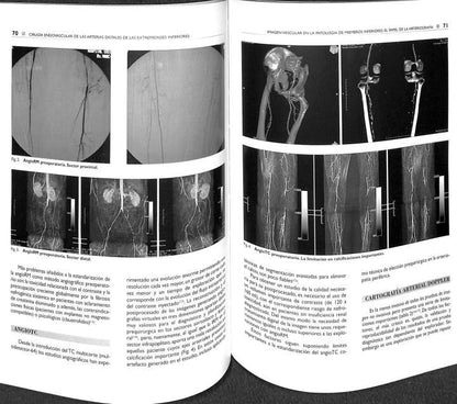 Cirugía Endovascular de las Arterias Distales del Miembro Inferior