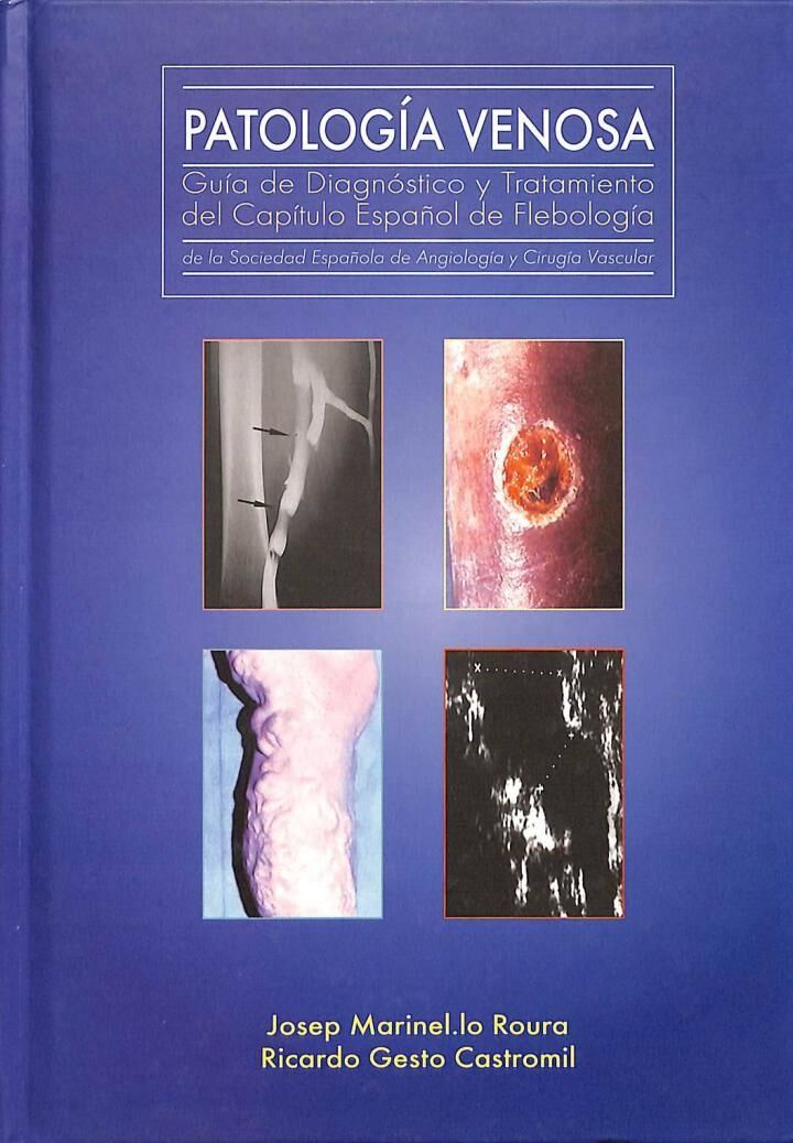 Patología Venosa: Guía de Diagnóstico y Tratamiento del Capítulo Español de Flebología de la Sociedad Española de Angiología y Cirugía Vascular