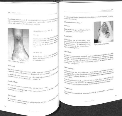 Patología Venosa: Guía de Diagnóstico y Tratamiento del Capítulo Español de Flebología de la Sociedad Española de Angiología y Cirugía Vascular