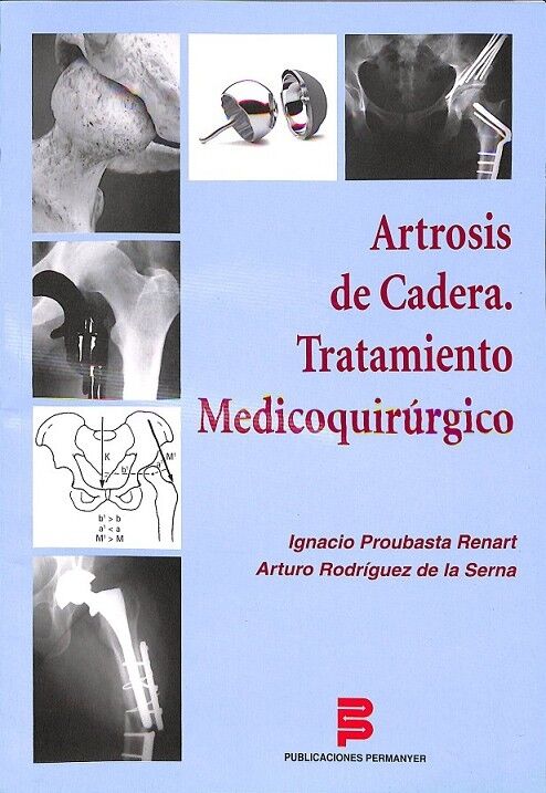 Artrosis de Cadera
