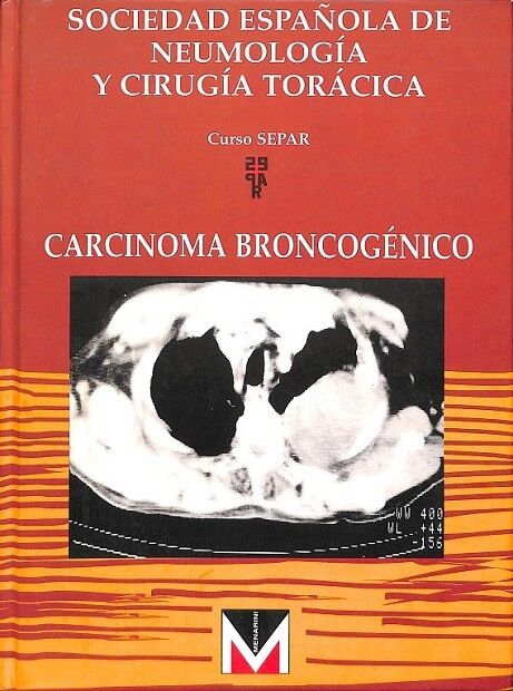 Carcinoma Broncogénico